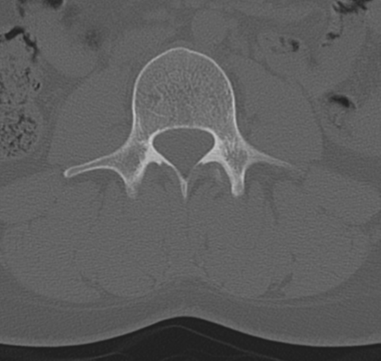 File:Normal lumbar spine CT (Radiopaedia 46533-50986 Axial bone window 34).png
