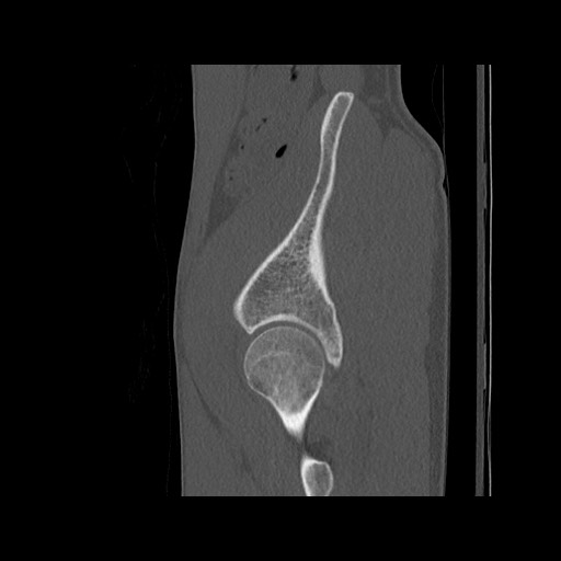 Normal pelvis (Radiopaedia 51473-57238 Sagittal bone window 118).jpg