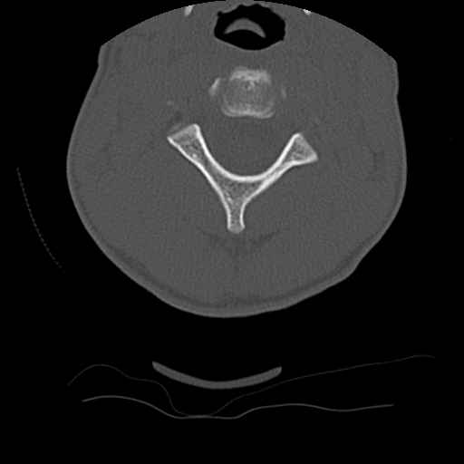 Normal trauma spine imaging (age 16) (Radiopaedia 45335-49358 Axial bone window 24).jpg