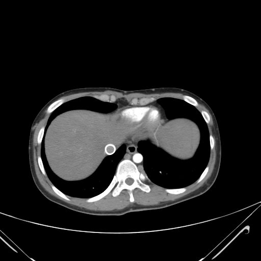 File:Nutmeg liver- Budd-Chiari syndrome (Radiopaedia 46234-50635 A 8).png