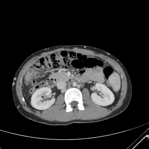 File:Nutmeg liver- Budd-Chiari syndrome (Radiopaedia 46234-50635 B 28).png
