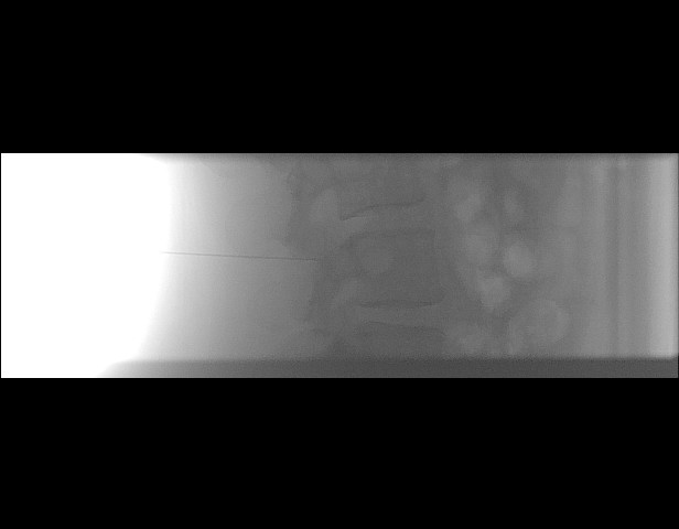 File:Oblique sublaminar lumbar puncture (Radiopaedia 90103-107280 A 8).jpeg