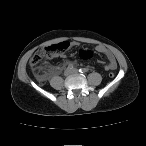 File:Obstructed kidney with perinephric urinoma (Radiopaedia 26889-27066 Axial non-contrast 40).jpg