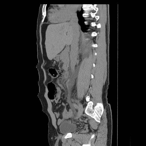 File:Obstructed kidney with perinephric urinoma (Radiopaedia 26889-27066 B 24).jpg