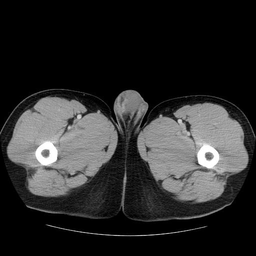File:Obstructing ureteric calculus (Radiopaedia 18615-18514 B 66).jpg