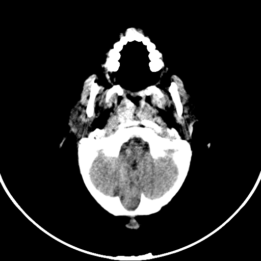 Occipital encephalocele (Radiopaedia 87339-103636 Axial non-contrast 18).jpg