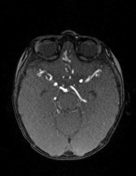 Occipital horn syndrome (Radiopaedia 14255-14129 MRA 62).jpg