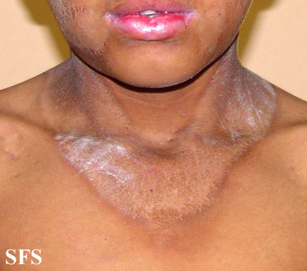 File:Pellagra (Dermatology Atlas 24).jpg