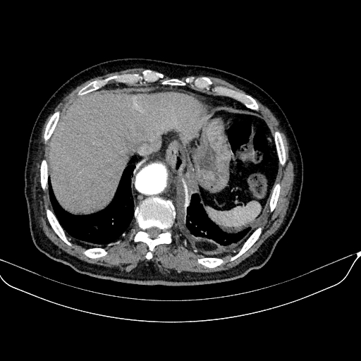 Abdominal aortic aneurysm (Radiopaedia 67117-76452 Axial C+ arterial phase 20).jpg