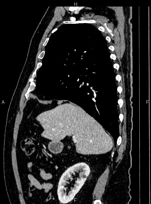 Abdominal aortic aneurysm (Radiopaedia 83094-97462 Sagittal renal cortical phase 40).jpg