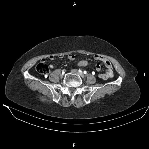File:Abdominal aortic aneurysm (Radiopaedia 85063-100606 Axial C+ arterial phase 51).jpg