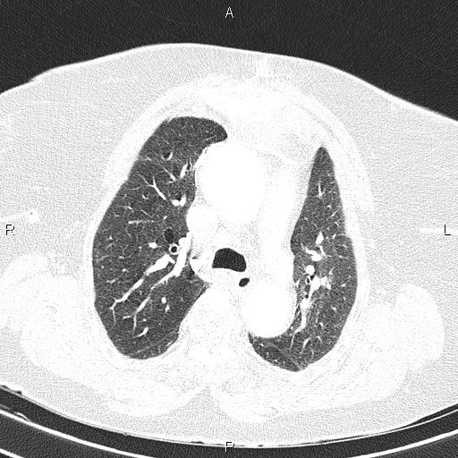 File:Abdominal aortic aneurysm (Radiopaedia 85063-100606 Axial lung window 26).jpg