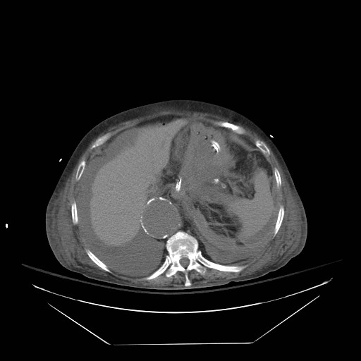 Abdominal aortic aneurysm - impending rupture (Radiopaedia 19233-19247 Axial non-contrast 40).jpg