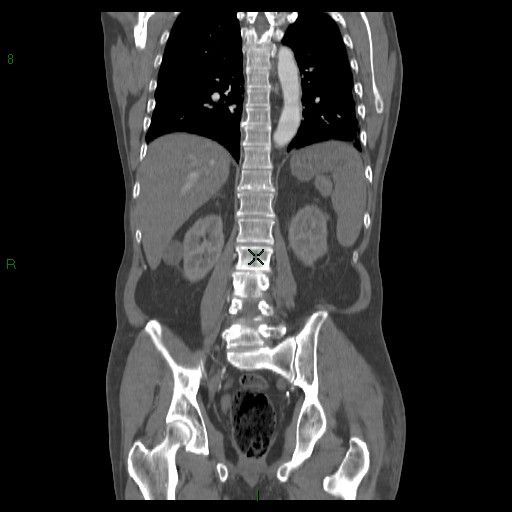 File:Abdominal aortic aneurysm rupture with aortocaval fistula (Radiopaedia 14897-14841 Coronal C+ arterial phase 31).jpg