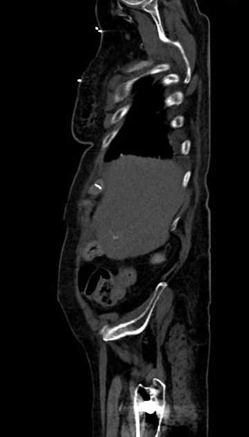 Abdominal aortic aneurysm with thrombus fissuration (Radiopaedia 73192-83919 Sagittal C+ arterial phase 125).jpg