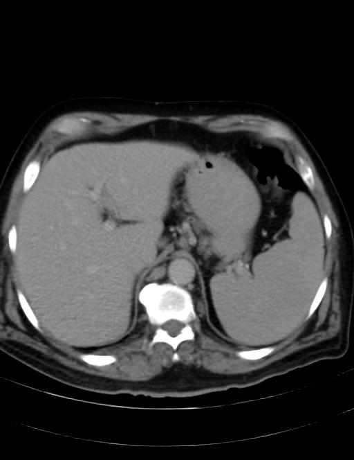 Abdominal lymphoma - with sandwich sign (Radiopaedia 53486-59492 Axial C+ portal venous phase 10).jpg