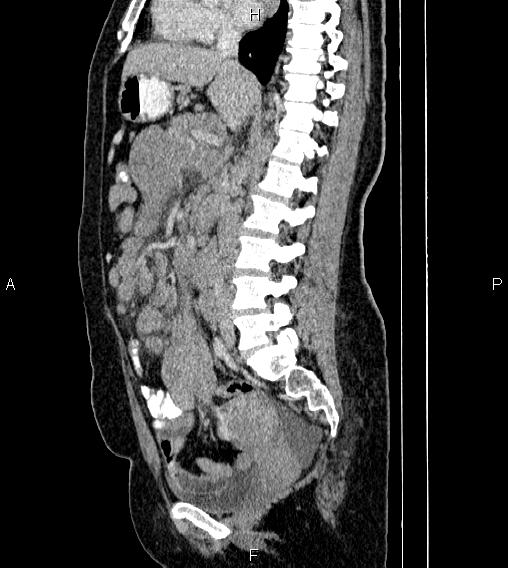 Abdominal lymphoma with sandwich sign (Radiopaedia 84378-99704 Sagittal C+ portal venous phase 41).jpg