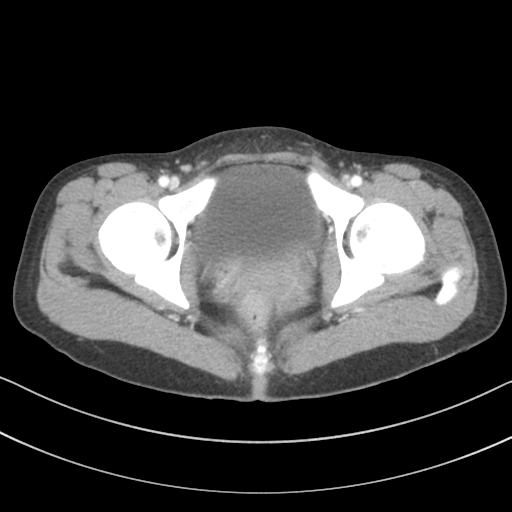 File:Abdominal multi-trauma - devascularised kidney and liver, spleen and pancreatic lacerations (Radiopaedia 34984-36486 Axial C+ portal venous phase 80).png
