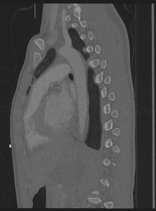 Abdominal multi-trauma - devascularised kidney and liver, spleen and pancreatic lacerations (Radiopaedia 34984-36486 Sagittal bone window 20).png