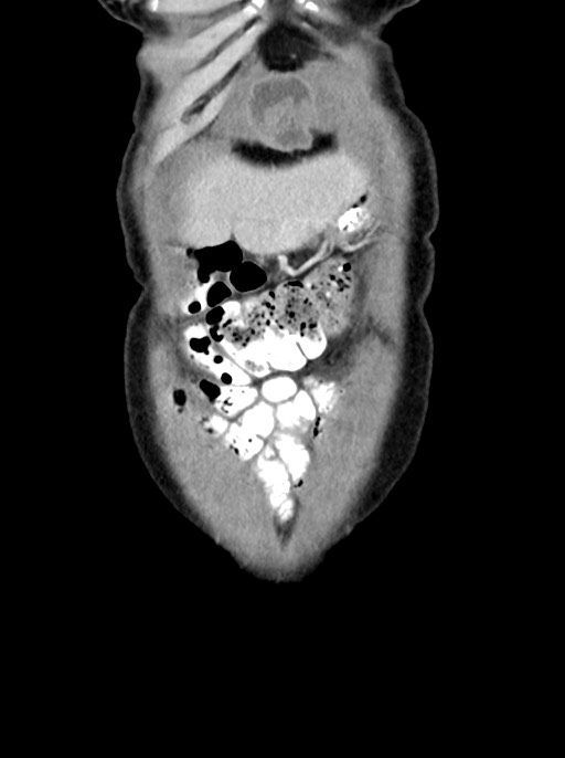 Abdominal wall and retroperitoneal tuberculosis (Radiopaedia 88137-104729 Coronal C+ portal venous phase 14).jpg