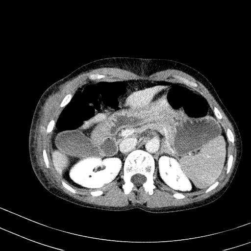 File:Abdominal wall hematoma with active bleeding (Radiopaedia 83915-99117 Axial C+ portal venous phase 7).jpg