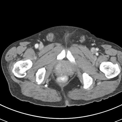 Abdominal wall metastasis from colorectal carcinoma (Radiopaedia 31016-31717 Axial C+ portal venous phase 79).jpg