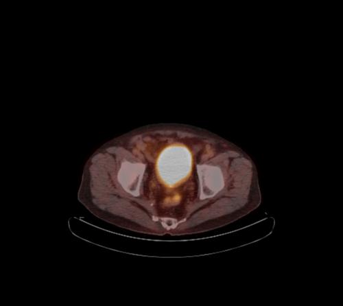 Abdominal wall metastasis from colorectal carcinoma (Radiopaedia 31016-31719 C 30).jpg