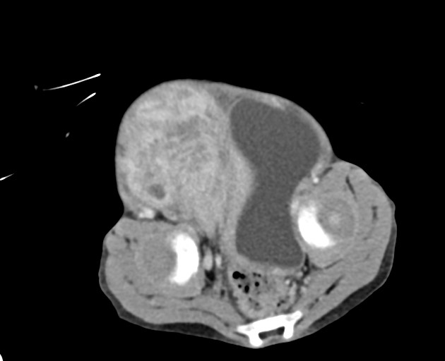 Abdominopelvic rhabdomyosarcoma (Radiopaedia 78356-90984 Axial C+ portal venous phase 141).jpg
