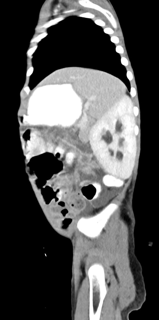 Abdominopelvic rhabdomyosarcoma (Radiopaedia 78356-90984 Sagittal C+ portal venous phase 22).jpg