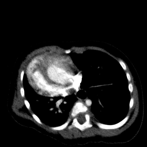 Aberrant left pulmonary artery (pulmonary sling) (Radiopaedia 42323-45435 Axial C+ CTPA 30).jpg