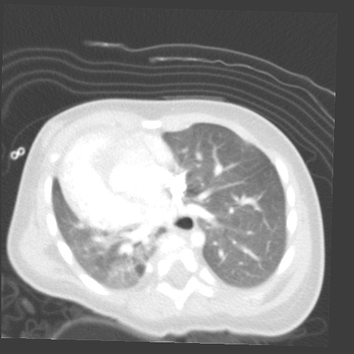 File:Aberrant left pulmonary artery (pulmonary sling) (Radiopaedia 42323-45435 Axial lung window 23).jpg