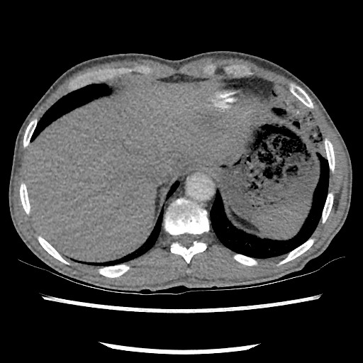Accessory left horizontal fissure with lingular pneumonia (Radiopaedia 53763-59843 Axial C+ CTPA 78).jpg