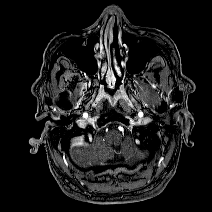 Accessory middle cerebral artery (Radiopaedia 73114-83828 Axial MRA 8).jpg