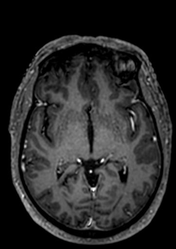 File:Accessory middle cerebral artery (Radiopaedia 73114-83828 Axial T1 C+ 49).jpg