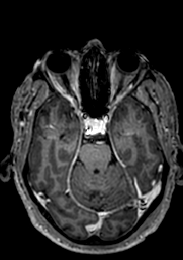 Accessory middle cerebral artery (Radiopaedia 73114-83828 Axial T1 C+ 95).jpg