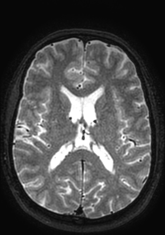 Accessory middle cerebral artery (Radiopaedia 73114-83828 Axial T2 45).jpg