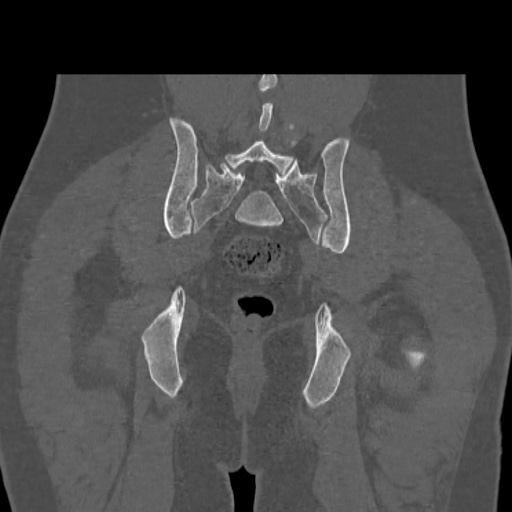 File:Acetabular and ilial fractures (Radiopaedia 59084-66378 Coronal bone window 42).jpg