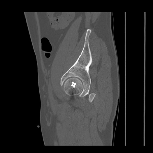 File:Acetabular and ilial fractures (Radiopaedia 59084-66378 Sagittal bone window 74).jpg