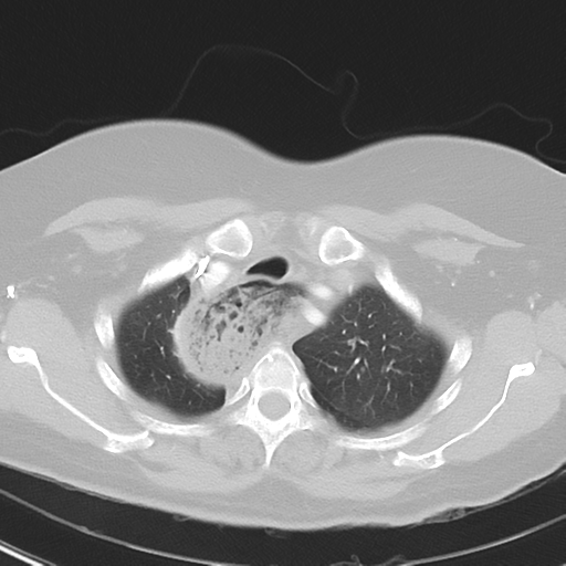 File:Achalasia (Radiopaedia 47147-51685 Axial lung window 10).png