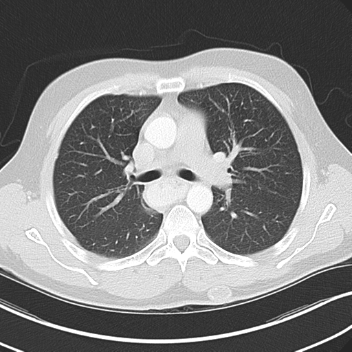 Achalasia of the cardia (Radiopaedia 38497-40595 Axial lung window 22).png