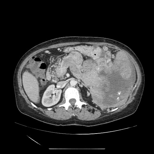 Acinar cell carcinoma of the pancreas (Radiopaedia 75442-86669 Axial C+ portal venous phase 54).jpg