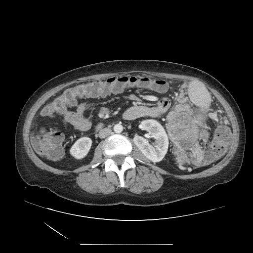 Acinar cell carcinoma of the pancreas (Radiopaedia 75442-86669 Axial C+ portal venous phase 72).jpg