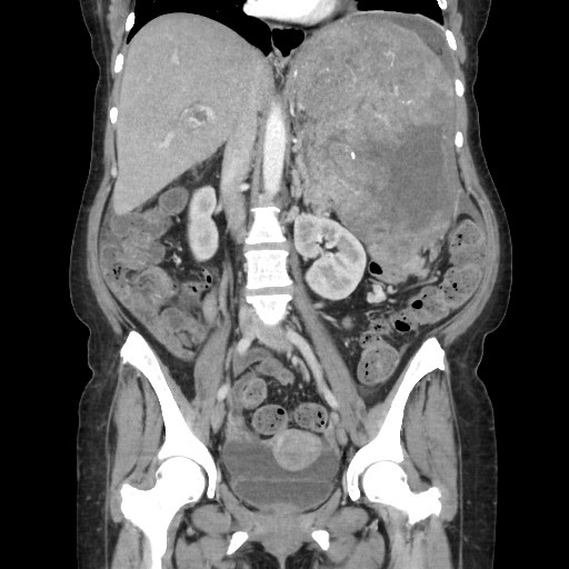 Acinar cell carcinoma of the pancreas (Radiopaedia 75442-86669 Coronal C+ portal venous phase 69).jpg