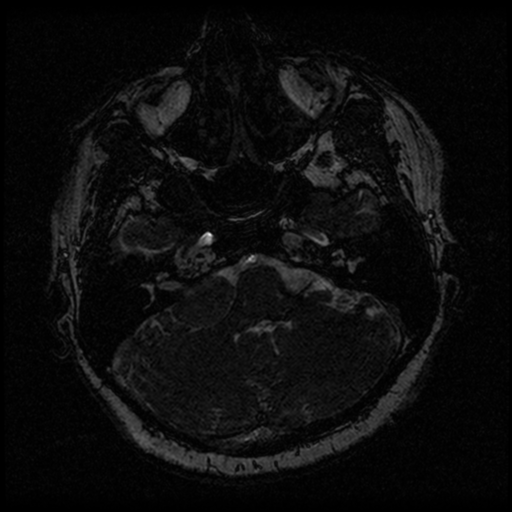 Acoustic schwannoma (Radiopaedia 33045-34060 Axial T2 21).png
