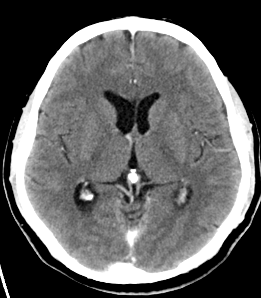 File:Acoustic schwannoma (Radiopaedia 33045-34065 Axial C+ delayed 13).png