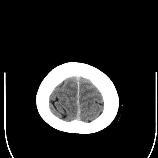 File:Acoustic schwannoma (Radiopaedia 39170-41389 Axial non-contrast 27).png