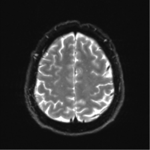 Acoustic schwannoma (Radiopaedia 50846-56358 Axial DWI 24).png