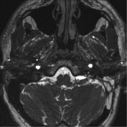 Acoustic schwannoma (translabyrinthine resection) (Radiopaedia 43570-46972 Axial CISS 13).png