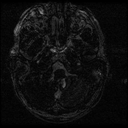 Acoustic schwannoma - eroding petrous apex (Radiopaedia 39674-42004 Axial T2 1).png