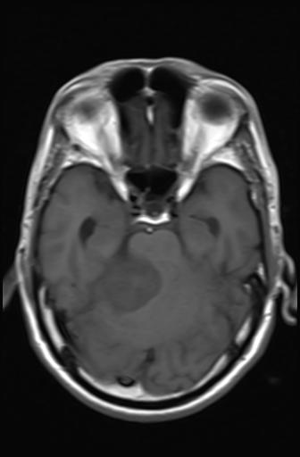 Acoustic schwannoma - probable (Radiopaedia 20386-20292 Axial T1 7).jpg